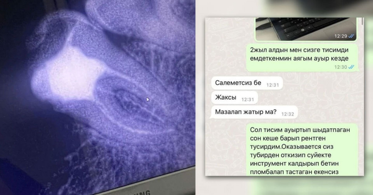Астаналық тұрғынның тісінде дәрігердің аспабы қалып кеткен