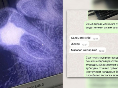 Астаналық тұрғынның тісінде дәрігердің аспабы қалып кеткен