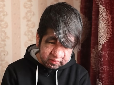 «Өз түрімнен ұяламын»: ақтаулық түкті баланың қазіргі жағдайы белгілі болды