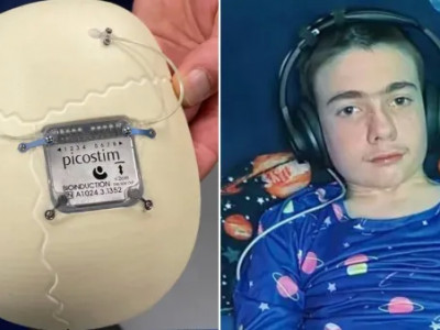 Дәрігерлер эпилепсиямен ауыратын жасөспірімнің миына нейростимулятор орнатты
