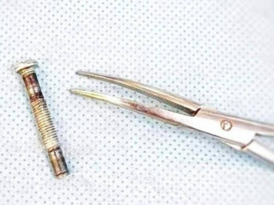 Түркістанда дәрігерлер көмейіне болт кіріп кеткен баланың өмірін сақтап қалды