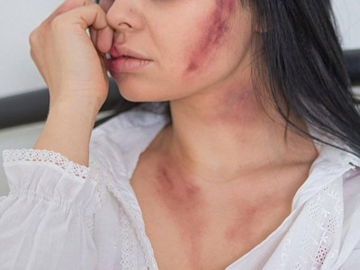 Шымкентте сүйіктісінің жағын сындырған жігіт сотталды