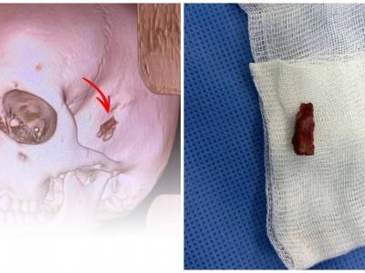 10 жастағы баланың басынан 5 жыл бұрын кірген бұтақ алынды