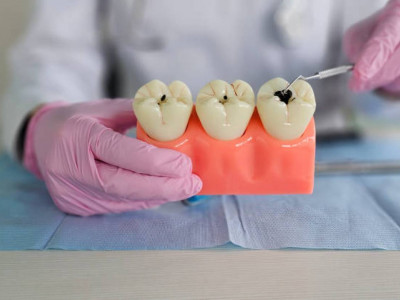 Тіс жегісінің алдын алатын жаңа тәсіл анықталды