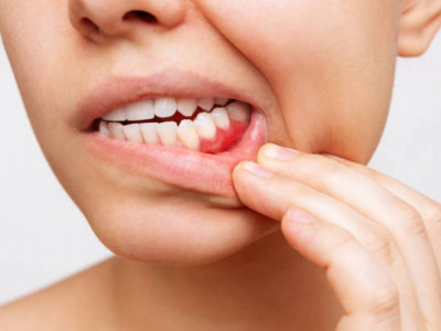 Кей жеміс-көкөністе болатын пигменттің жетіспеуі қызыл иек ауруына шалдықтыруы мүмкін