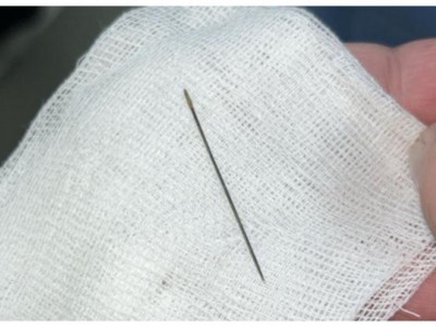 Түркістанда 8 айлық сәбидің ішкі құрылысынан ине табылды