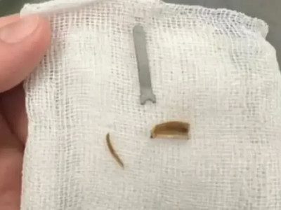 Ақтауда 11 айлық сәбидің өкпесінен металл табылды