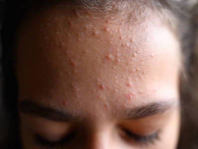 Дерматолог неліктен маңдайда безеу пайда болатынын түсіндірді