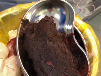 Түркістан облысында 15 жастағы қыздың асқазанынан 1 келі шаш шықты