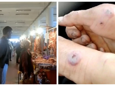 «Базардағы еттен тараған»: Шымкентте аса қауіпті жұқпалы ауру жұқтырған адам анықталды