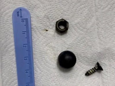 Шымкентте дәрігерлер баланың ішегінен магнит, бұранда және гайканы алып шықты