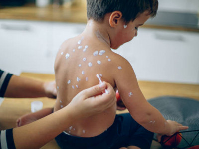 БҚО-да баладан қызылшаның өлімге әкелуі мүмкін қауіпті асқынуы анықталды