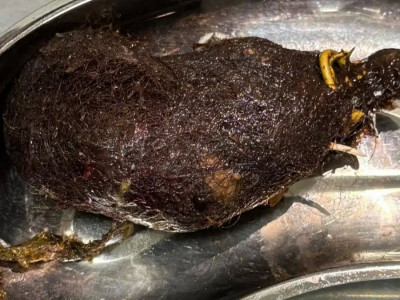 Алматыда шашын жей беретін 12 жастағы қыздың асқазанына ота жасалды