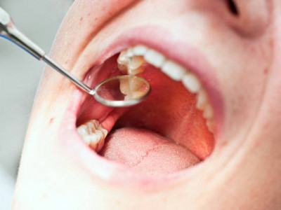 Тіс дәрігері жасырын тіс жегі белгілерін атады