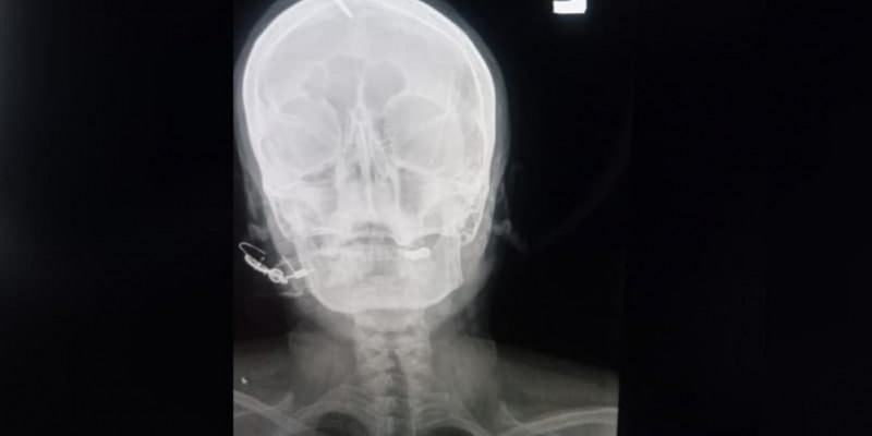 Пәкістандық әйел ұл туу үшін өз басына шеге қақты