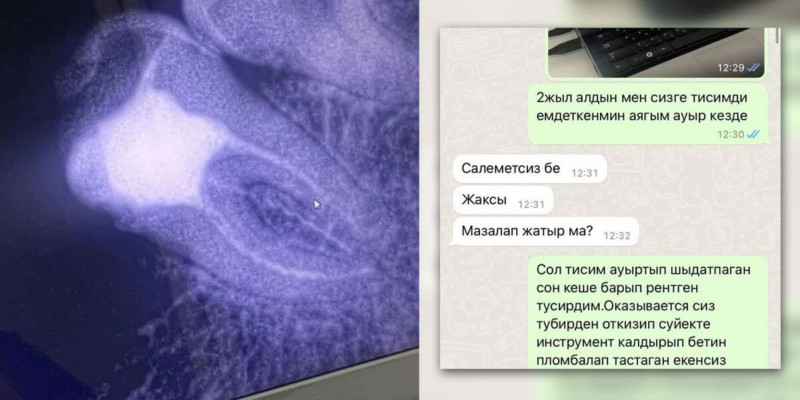 Астаналық тұрғынның тісінде дәрігердің аспабы қалып кеткен