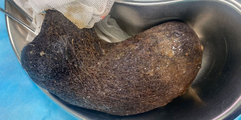 Алматыда 11 жастағы қыздың асқазанынан бір келі шаш шықты