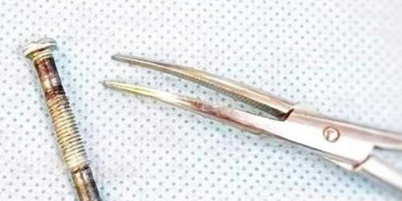 Түркістанда дәрігерлер көмейіне болт кіріп кеткен баланың өмірін сақтап қалды