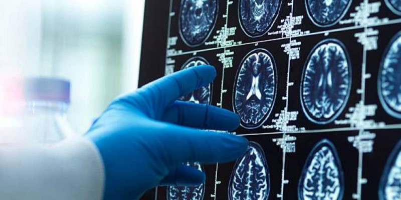 "Нағыз таңғажайып оқиға": 18 ай ғана өмірі қалған 27 жастағы қыз ми ісігін жеңіп шыққан