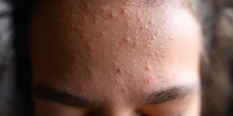 Дерматолог неліктен маңдайда безеу пайда болатынын түсіндірді