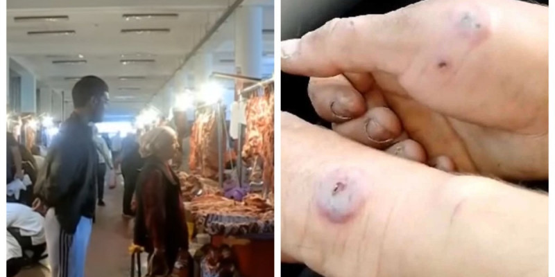 «Базардағы еттен тараған»: Шымкентте аса қауіпті жұқпалы ауру жұқтырған адам анықталды