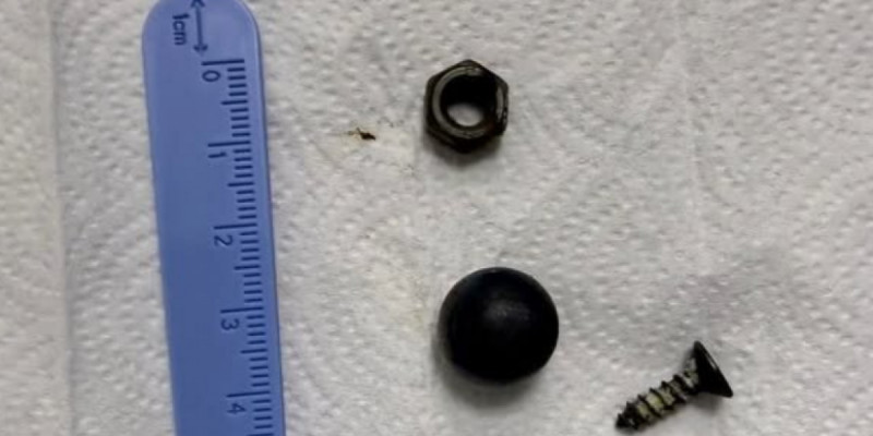 Шымкентте дәрігерлер баланың ішегінен магнит, бұранда және гайканы алып шықты