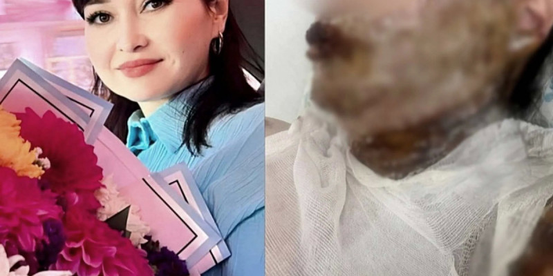 Шымкентте әйелдің бетіне бұрынғы күйеуі қышқыл шашқан: оқиғаның мән-жайы белгілі болды