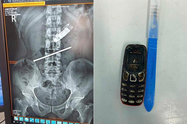 Қызылордалық дәрігерлер телефон жұтып қойған азаматты құтқарды
